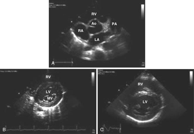 Fig. 14.6, Echocardiogram in the parasternal short-axis view sweeping from the base (A) to the apex (C) of the heart. Ao, Aorta; LA, left atrium; LV, left ventricle; MV, mitral valve; PA, pulmonary artery; RA, right atrium; RV, right ventricle.