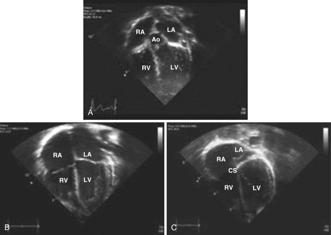 Fig. 14.7, Echocardiogram in the apical four-chamber view sweeping anterior (A) to posterior (C). Ao, Aorta; CS, coronary sinus; LA, left atrium; LV, left ventricle; RA, right atrium; RV, right ventricle.