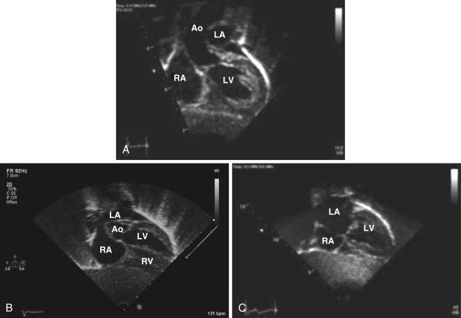 Fig. 14.8, Echocardiogram in the subcostal coronal view sweeping anterior (A) to posterior (C). Ao, Aorta; LA, left atrium; LV, left ventricle; RA, right atrium; RV, right ventricle.