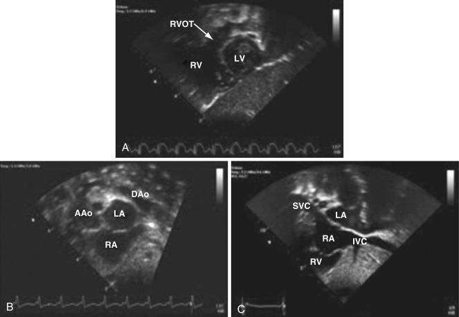 Fig. 14.9, Echocardiogram in the subcostal sagittal view sweeping apex (A) to base (C). AAo, Ascending aorta; DAo, descending aorta; IVC, inferior vena cava; LA, left atrium; LV, left ventricle; RA, right atrium; RV, right ventricle; RVOT, right ventricular outflow tract; SVC, superior vena cava.