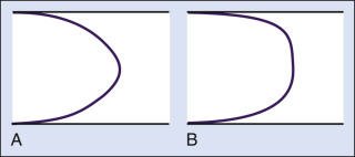 FIG. 1.3, Blood flow velocity profiles across an arterial lumen. (A) This parabolic profile is typical of normal laminar flow. The velocity is maximal in the center of the artery and lowest near the artery wall and decreases toward the artery wall according to Eq. 1.1 . (B) Flattened profile with a central core of relatively uniform velocity encountered at the site of a maximal stenosis. This flow profile is also maintained in the velocity jet before it dissipates. It is an idealized representation of blood flow because viscous forces will always impair the motion of red blood cells so that they are not moving at the same velocity.