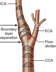 FIG. 1.5, This representation of the carotid artery bifurcation displays the principal alterations that take place in a normal bifurcation. The flow profile in the distal common carotid artery ( CCA ) starts to deviate from a laminar pattern to one favoring the internal carotid artery ( ICA ). As the red cells enter the carotid sinus, a zone of boundary layer separation (where the effective velocity is zero) appears. On one side of the zone of boundary separation, blood flow is reversed, whereas blood continues forward on the other side. Blood flow reestablishes a laminar pattern more distally in the ICA. For purposes of illustration, the actual effects of the external carotid artery ( ECA ) on blood flow are neglected.