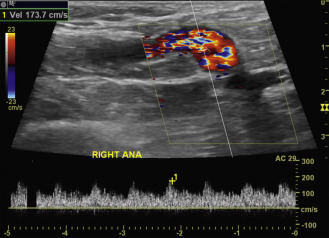 FIG. 1.6, The portion of this dialysis access just after the arterial anastomosis ( ANA ) has a relatively large diameter and moderately increased velocity. The combination of an elevated velocity in a larger diameter conduit increases the Reynolds number to be high enough for blood flow to transition into turbulence (shaggy and irregular contour of the Doppler waveform).