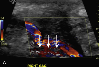 FIG. 1.7, (A) This color Doppler image is taken at the distal anastomosis of an iliofemoral graft. The color Doppler signals propagated into the soft tissues ( white arrows ) represent soft tissue vibrations, described as a color bruit artifact. (B) The Doppler gate has been moved over the soft tissues and the Doppler tracings show low frequency signals that are bidirectional, correspond to the soft tissue vibrations, and are representative of a bruit.