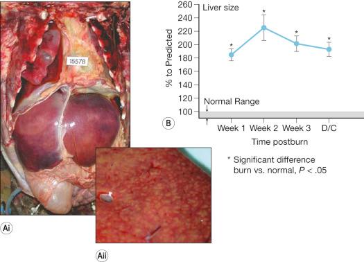 Fig. 24.1, A, Massive hepatomegaly (i) and hepatic fatty infiltration (ii) of a burn victim at autopsy. B, Liver size increased throughout acute hospitalization by over 200% in 242 surviving burn patients.