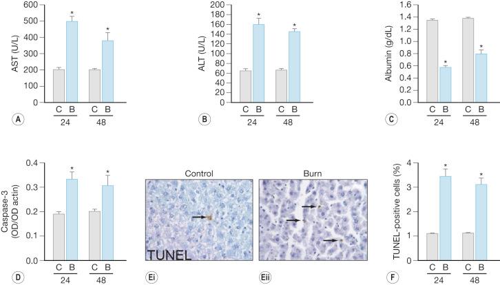 Fig. 24.2, Hepatic dysfunction of the rat burn model mimics the postburn human disease state. A, Serum aspartate amino transferase (AST) 24 and 48 hours after thermal injury. B, Serum alanine amino transferase (ALT) 24 and 48 hours after thermal injury. C, Serum albumin 24 and 48 hours after thermal injury. D, Caspase-3 activity in liver lysates as determined by successive Western blotting with active caspase-3 and actin antibodies. The data are expressed as a ratio of the two band intensities. E, TUNEL staining of a liver section before (i) and 24 hours after (ii) thermal injury. F, Quantified TUNEL-positive cells 24 and 48 hours after thermal injury. Time after injury in hours is indicated.