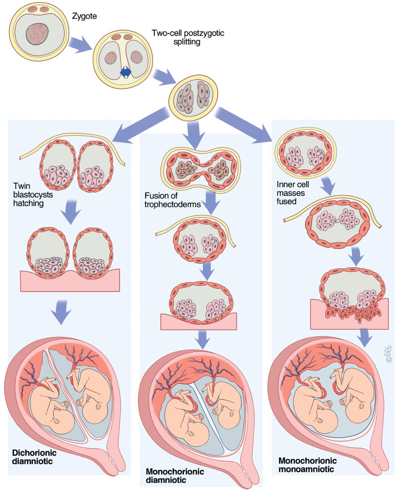 Fig. 117.3, Fusion theory of monozygotic twinning.