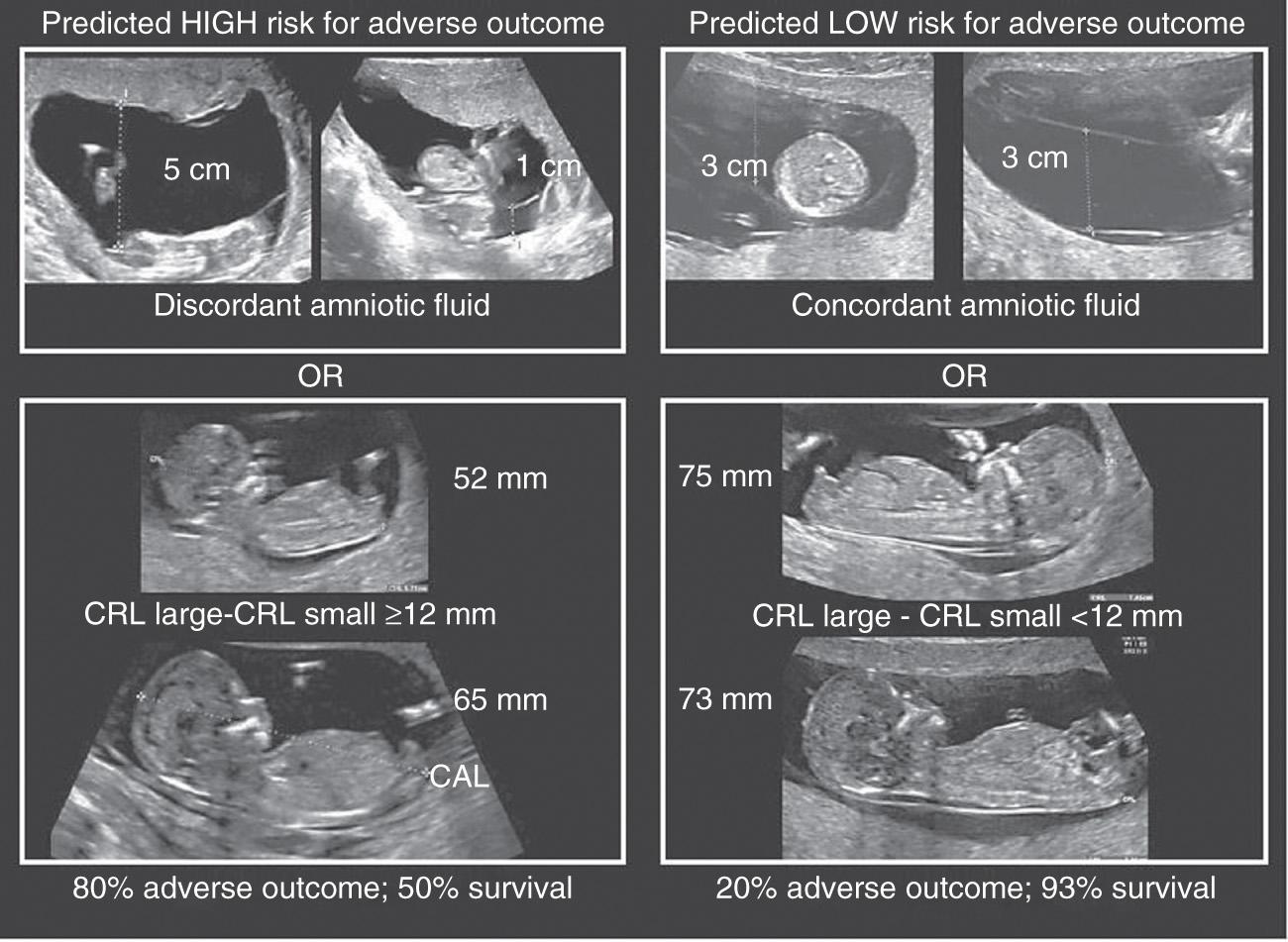 Fig. 117.4, Representation of first-trimester risk assessment for the development of discordant growth, twin-twin transfusion syndrome (TTTS), or intrauterine demise.