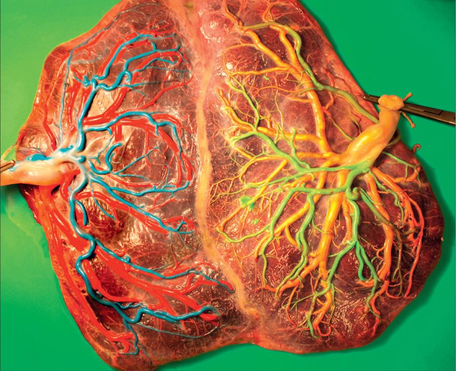 Fig. 117.5, Color-dye-stained twin-to-twin transfusion syndrome placenta that was treated using the Solomon technique.