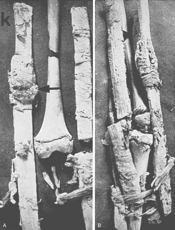 Fig. 74.1, A and B, Specimen of a fracture of an adolescent femur from circa 300 bc , excavated at Naga-ed-Der in 1903. This injury was an open fracture, and the absence of any callus ( arrow in A ) indicates early death.