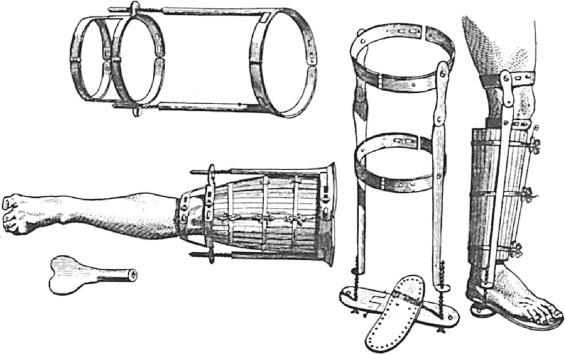 Fig. 74.3, Benjamin Gooch described the first functional brace in 1767. Note the similarity to Gersdorf's bindings.