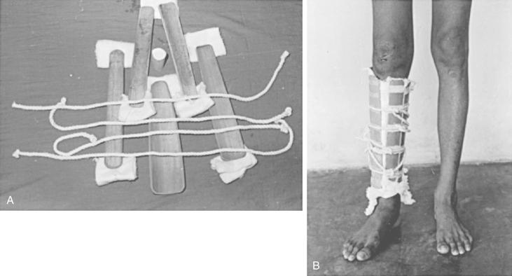 Fig. 74.4, A and B, Bamboo functional bracing currently in use in Sri Lanka.