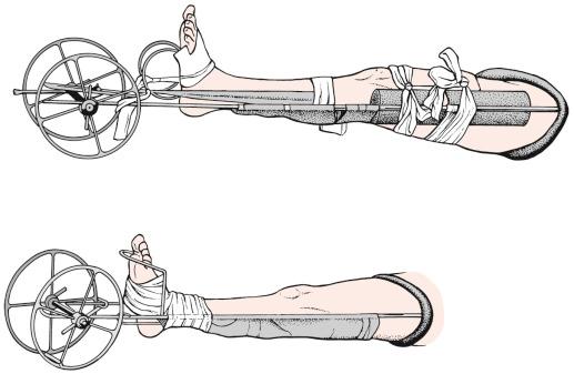 Fig. 74.7, Early Thomas splint.