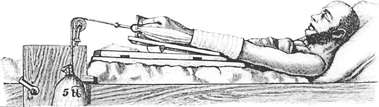 Fig. 74.9, Forearm skin traction for the treatment of T fractures of the distal humerus.