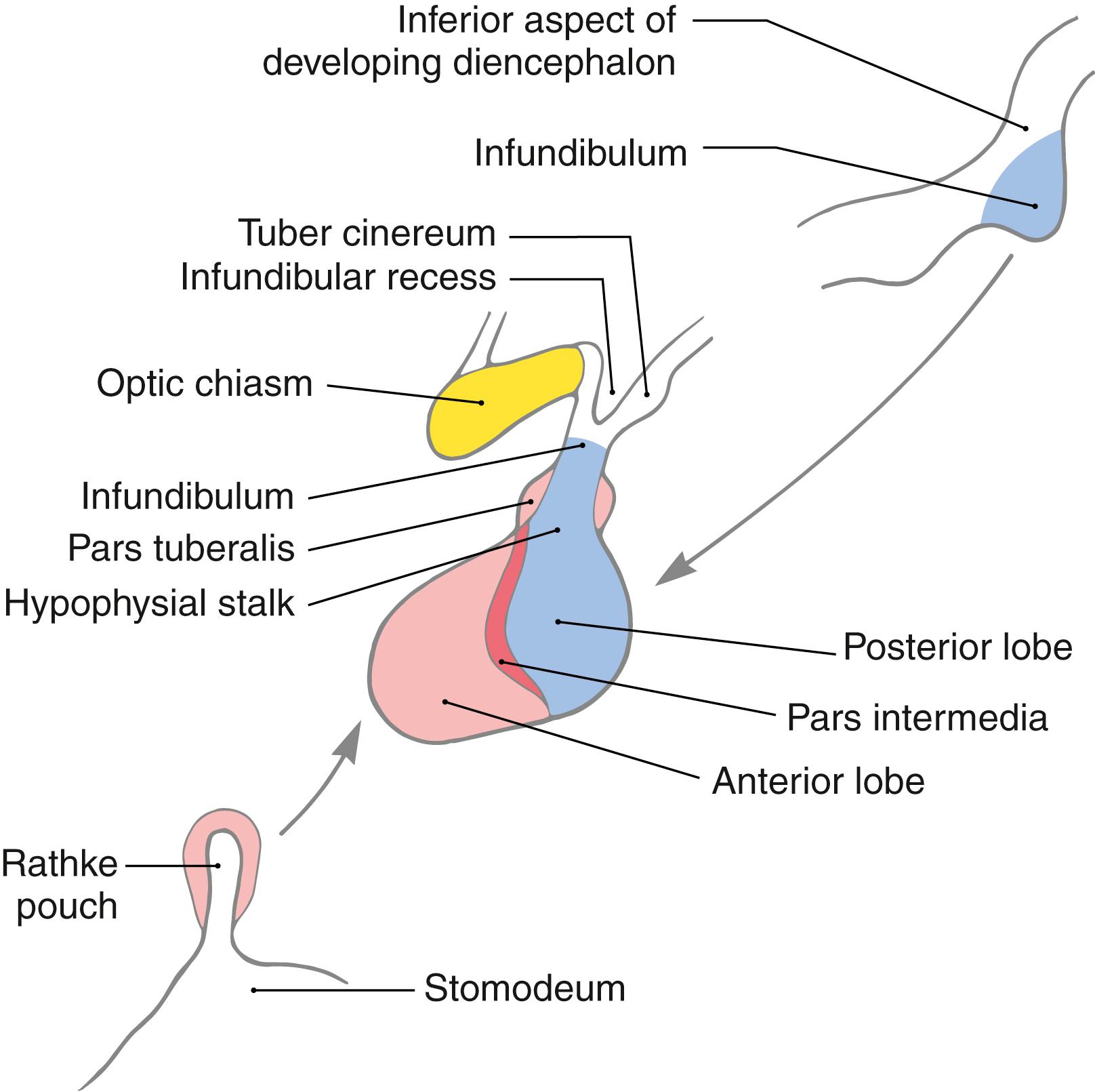 Fig. 30.3, The contributions from the stomodeum and the developing brain to the formation of the pituitary of the adult. Developmental defects in this area may give rise to a craniopharyngioma, also called a Rathke pouch tumor.