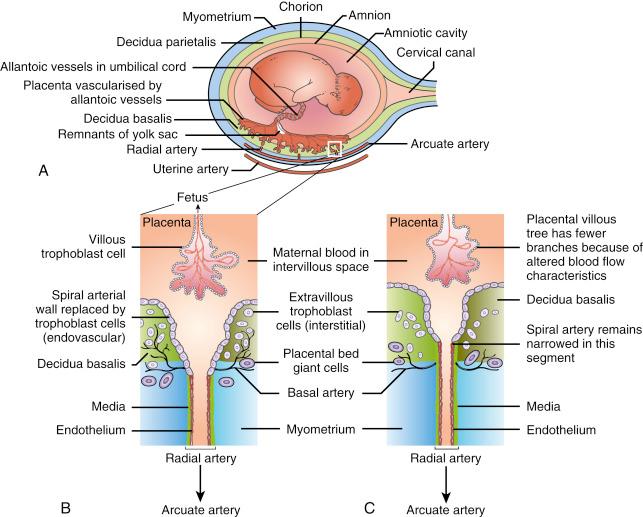 • Fig. 6.2, Disorders of human pregnancy resulting from abnormal placentation. A, The blood supply to a human pregnant uterus. B, Normal pregnancy. Maternal blood flow to the intervillous space begins at around 10 weeks’ gestation. The spiral arteries of the placental bed are converted to uteroplacental arteries by the action of migratory extravillous trophoblast cells. Both the arterial media and the endothelium are disrupted by trophoblast cells, converting the artery into a wide-calibre vessel that can deliver blood to the intervillous space at low pressure. The small basal arteries are not involved and remain as nutritive vessels to the inner myometrium and decidua basalis. C, Pre-eclampsia and fetal growth restriction. When trophoblast cell invasion is inadequate, there is deficient transformation of the spiral arteries. The disturbed pattern of blood flow leads to reduced growth of the branches of the placental villous tree, which results in poor fetal growth.