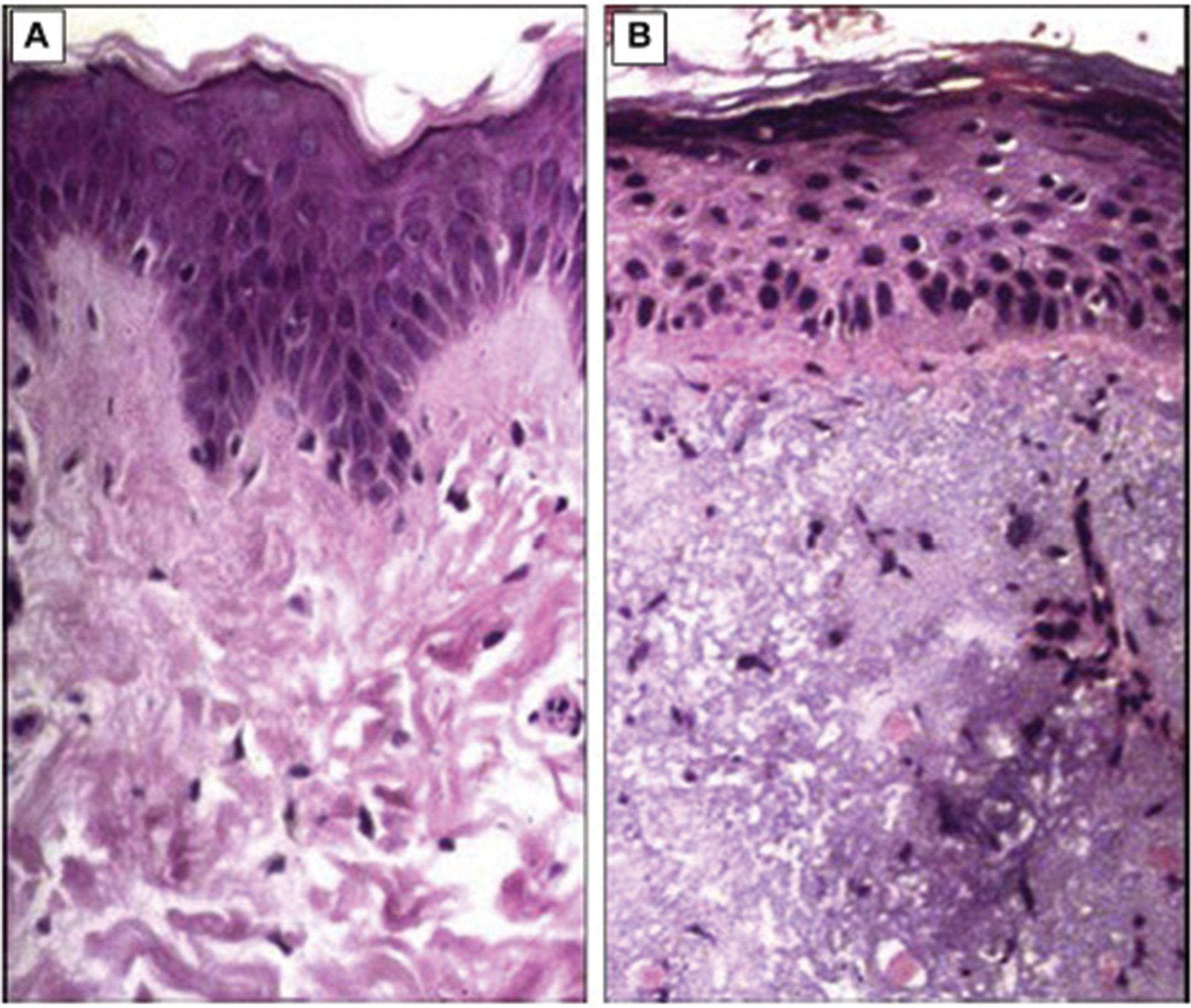 Fig. 12.5, Comparison of normal skin (A) and photodamaged skin (B) on histologic examination.