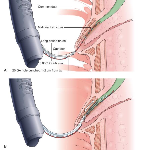 FIG 60.2, A, Monorail brush: a long-nosed brush is preloaded into a diagnostic catheter and passed with the catheter over a guidewire in a monorail fashion through the stricture. B, The monorail catheter has been passed over the end of the guidewire well above the stricture. Once off the guidewire, the long-nosed brush can be advanced to brush the stricture. The long nose maintains access. The guidewire remains in place.