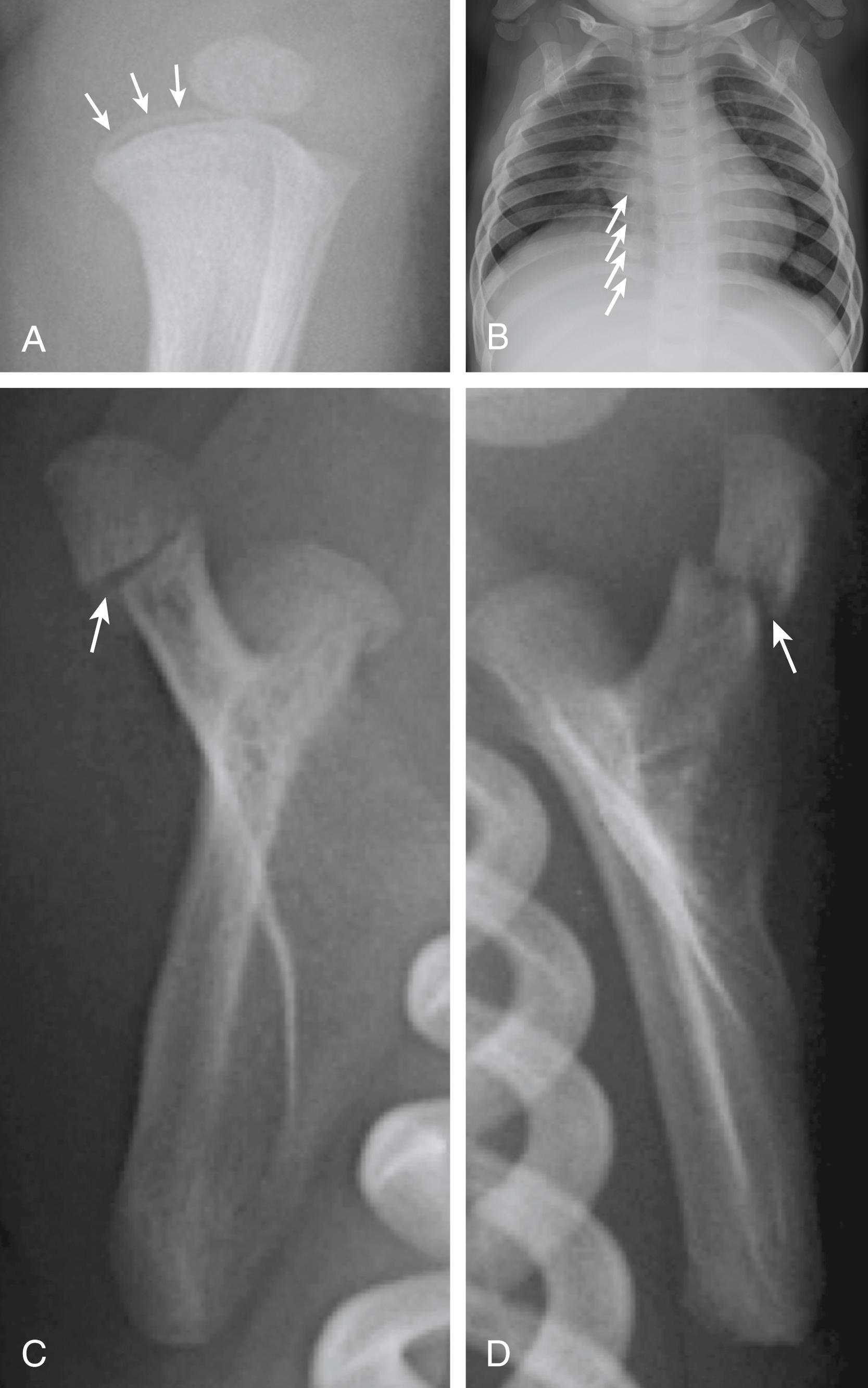 Fig. 30.5, Child abuse. A, Radiograph of the proximal lower leg in a 23-day-old infant with fussiness and suspected lower extremity pain reveals a classic metaphyseal lesion of the proximal tibia with a bucket-handle configuration (arrows) . B, Chest radiograph in a 12-month-old boy presenting with constipation reveals multiple consecutive rib fractures, seen posteriorly near the costovertebral junctions (arrows) . Fractures are healing, with callous formation evident. The patient had several additional rib head fractures better profiled on other views obtained as part of a complete skeletal survey. C, D, Radiographic views of the bilateral scapulae reveal minimally displaced fractures of the acromion processes (arrows) in an infant with multiple fractures of different ages on skeletal survey.