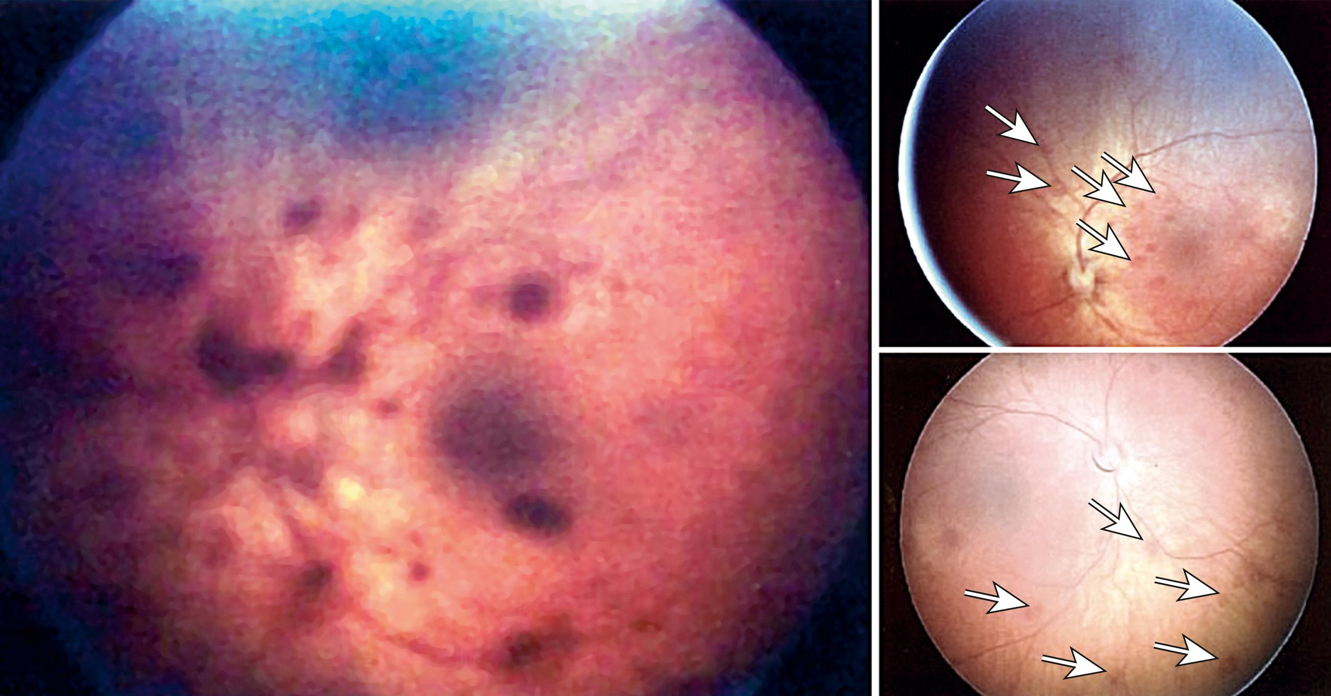 Fig. 30.6, Retinal hemorrhages. Arrows point to hemorrhages of various sizes.