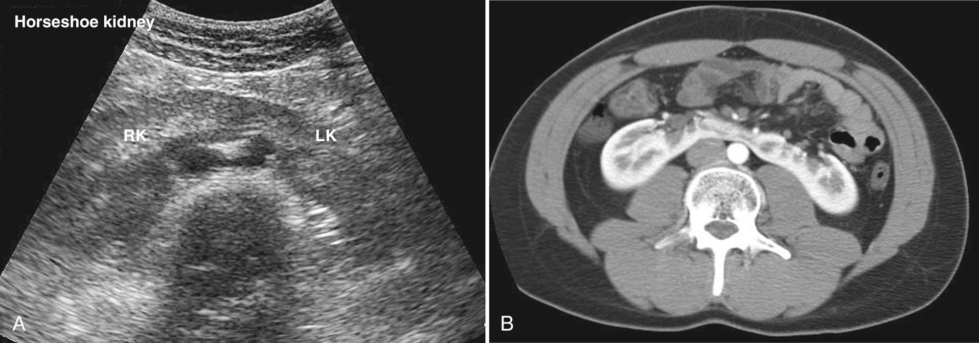 FIG. 9.11, Horseshoe Kidney.