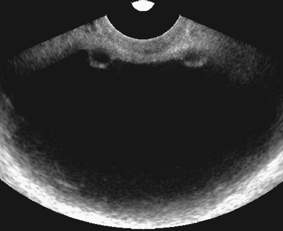 FIG. 9.14, Small Bilateral Ureteroceles.