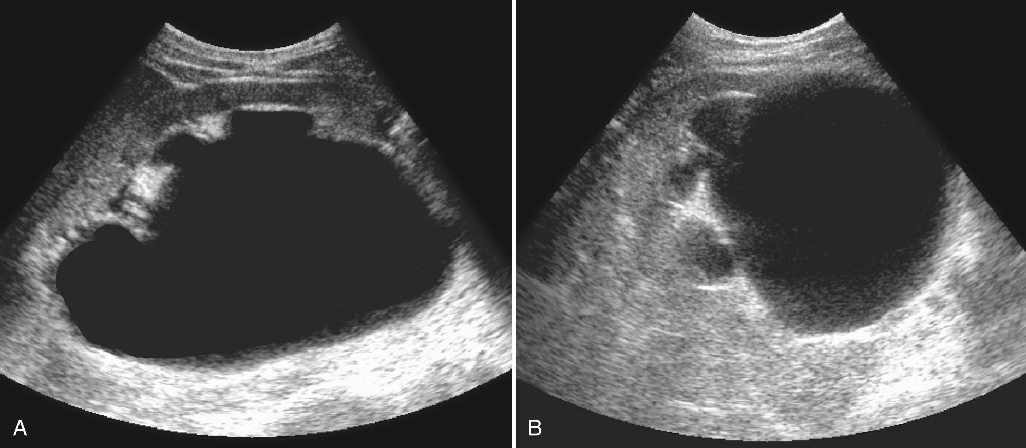 FIG. 9.15, Ureteropelvic Junction Obstruction.