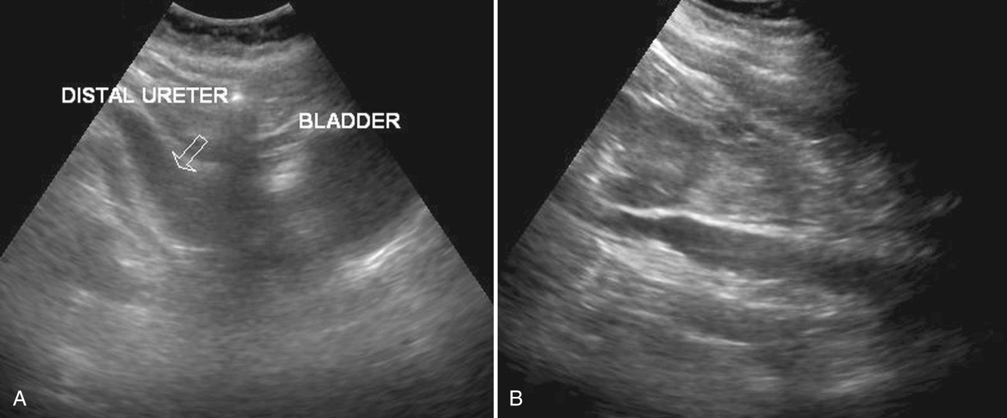 FIG. 9.16, Congenital Megaureter.