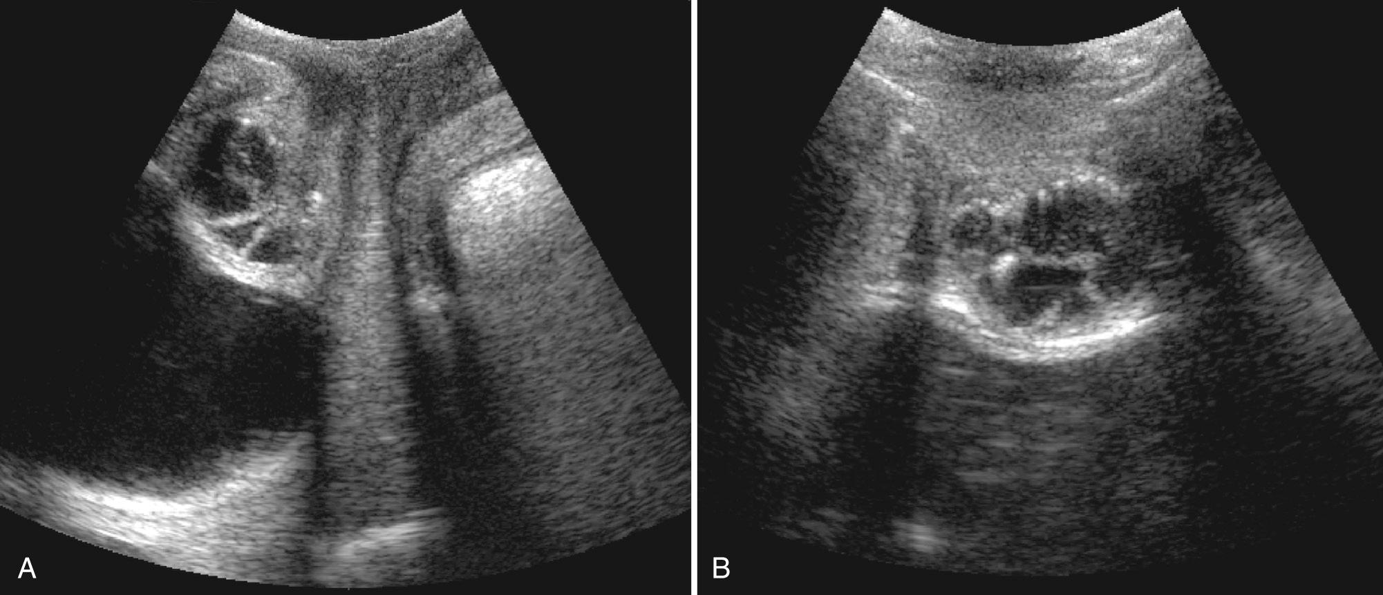 FIG. 9.18, Urethral Diverticulum in Young Woman With Palpable Vaginal Mass.