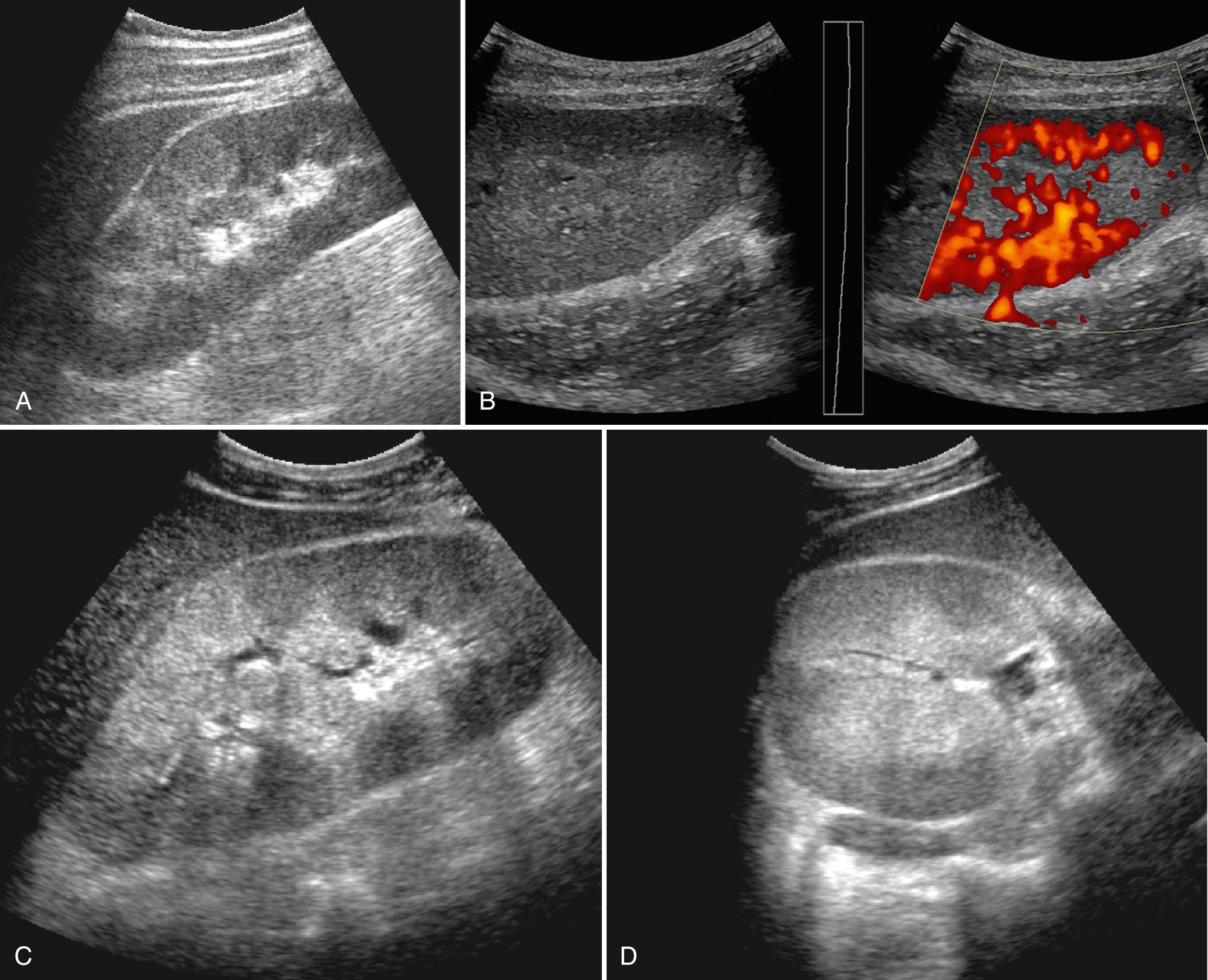 FIG. 9.19, Acute Pyelonephritis in Three Patients.