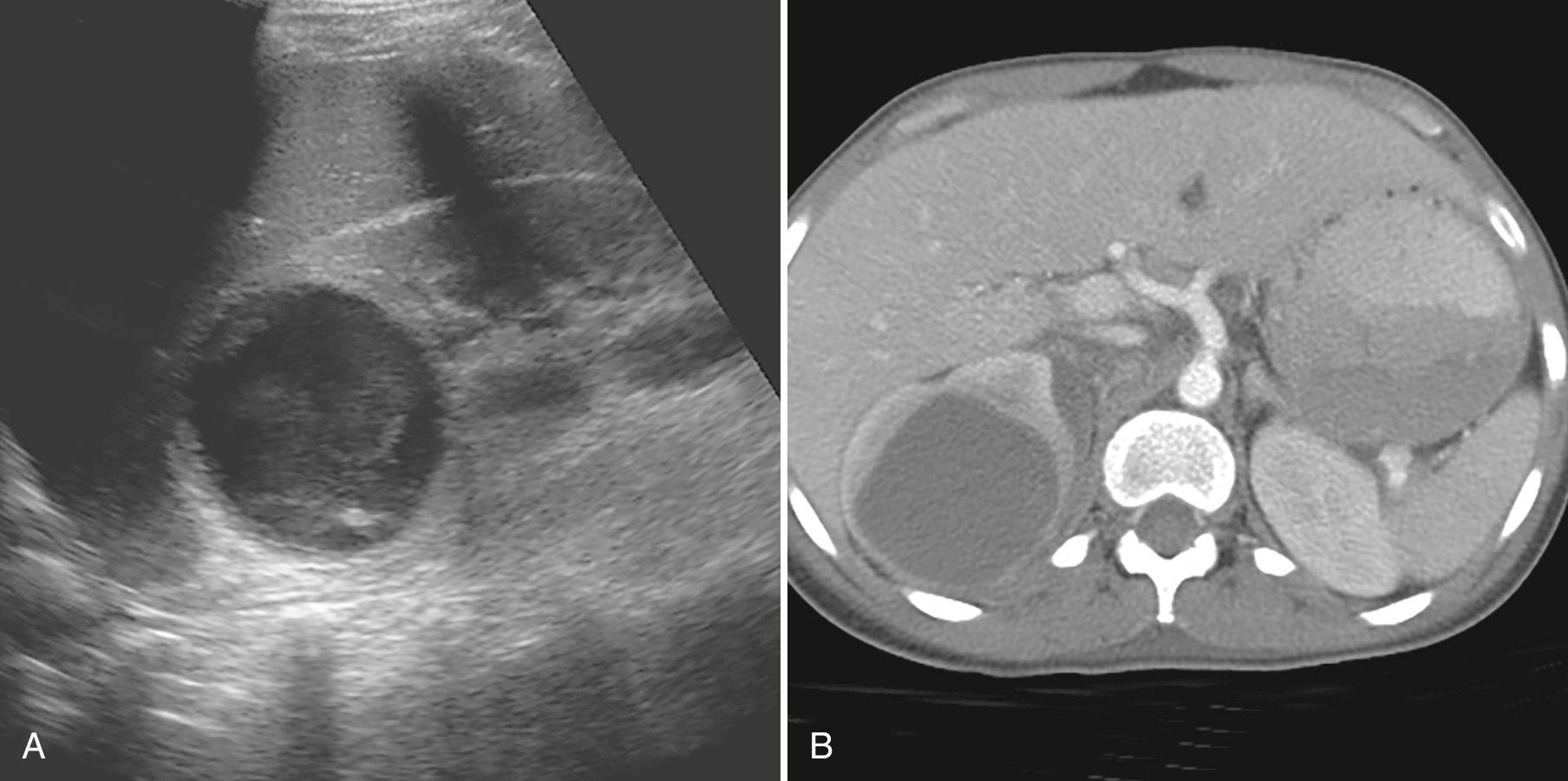 FIG. 9.20, Renal Abscess.