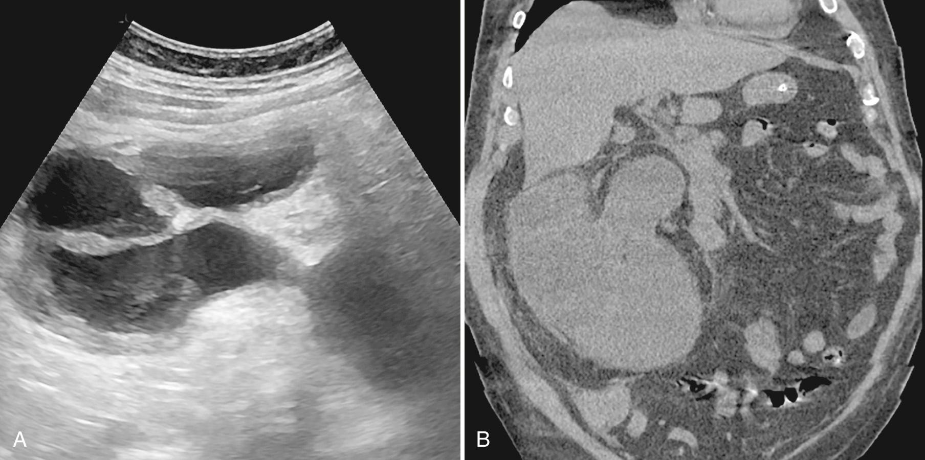 FIG. 9.21, Pyonephrosis.