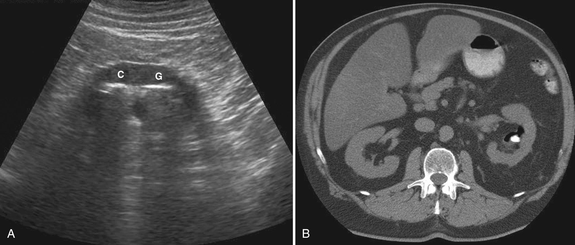 FIG. 9.23, Emphysematous Pyelitis.