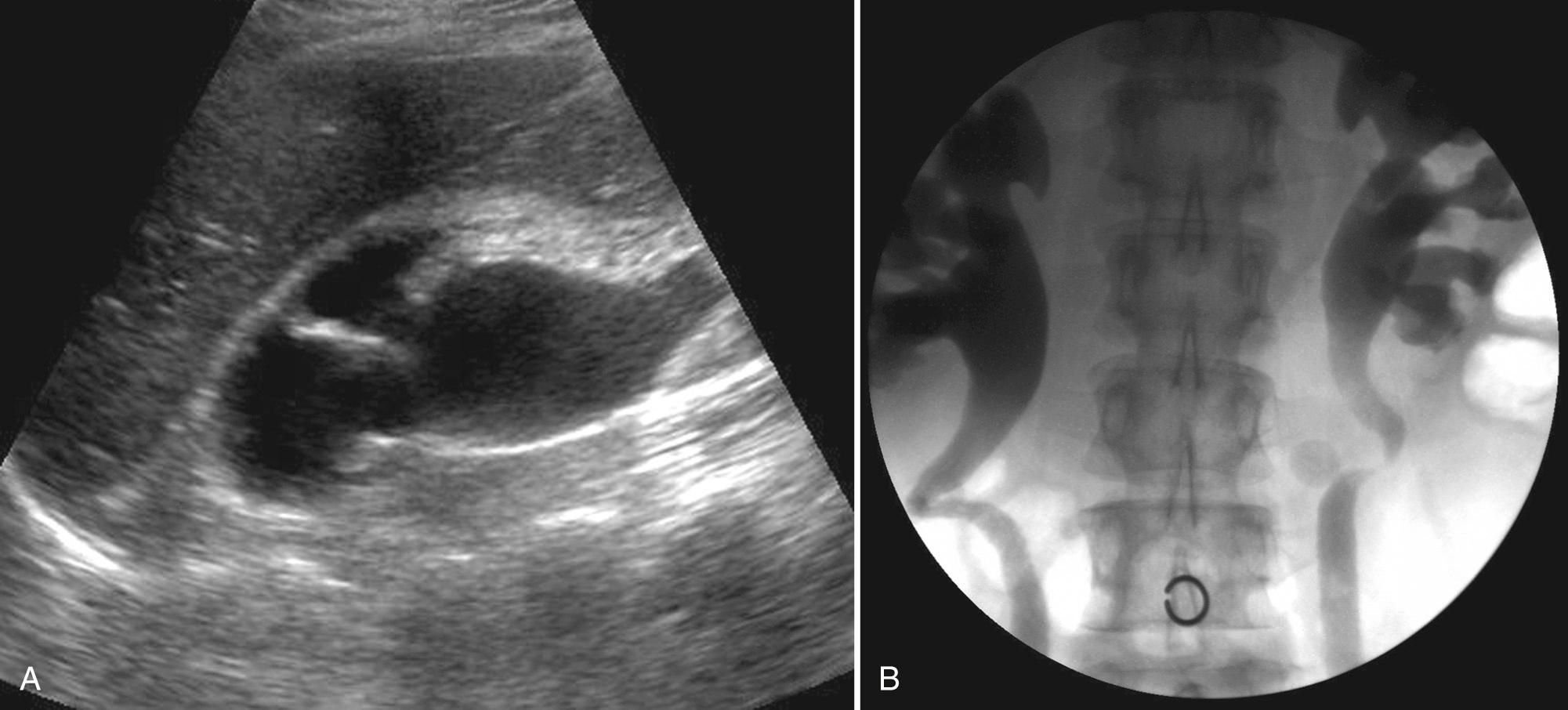 FIG. 9.24, Reflux Nephropathy: Renal Transplantation Evaluation.