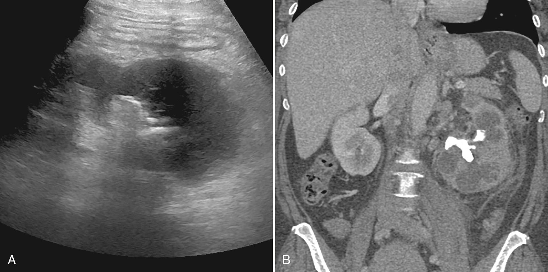 FIG. 9.26, Xanthogranulomatous Pyelonephritis.