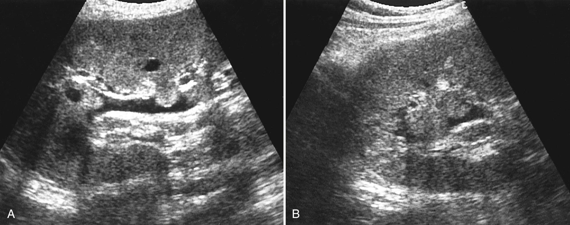 FIG. 9.27, Papillary Necrosis.