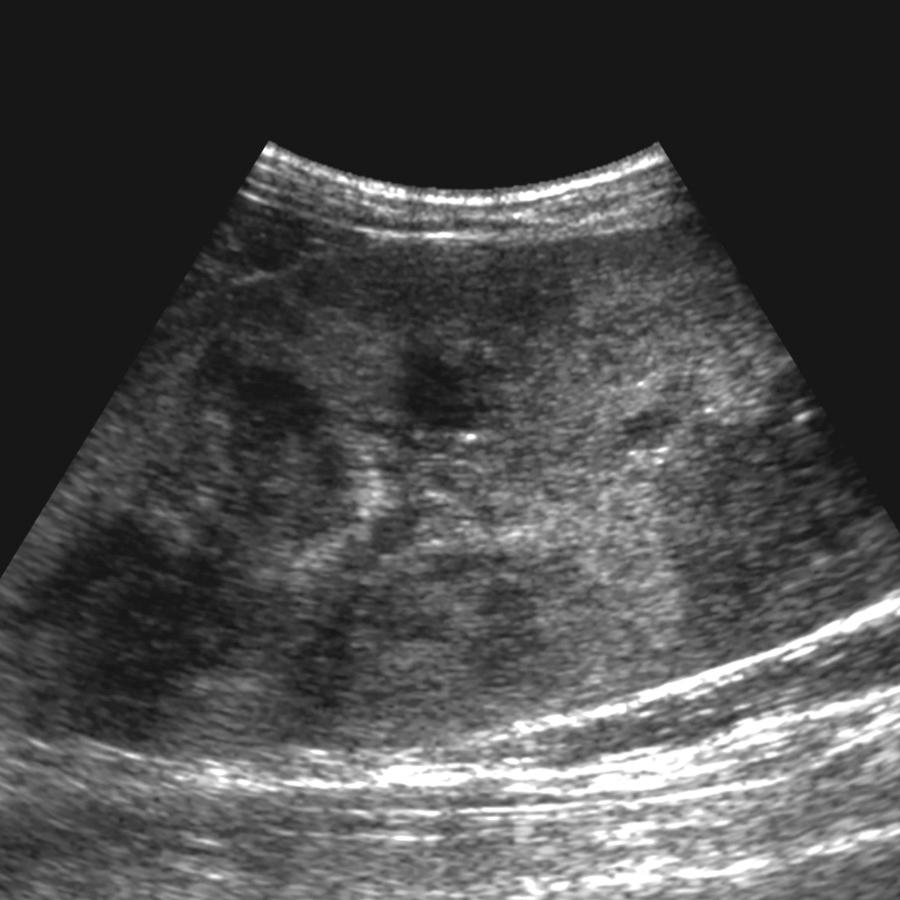 FIG. 9.28, Progressive Renal Tuberculosis.