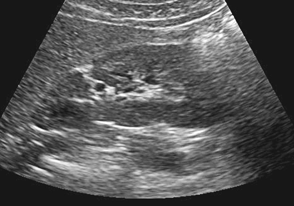 FIG. 9.5, Anterior Junction Line.