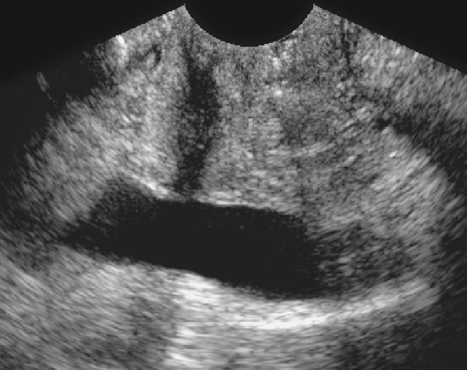 FIG. 9.7, Translabial Ultrasound of Female Urethra.