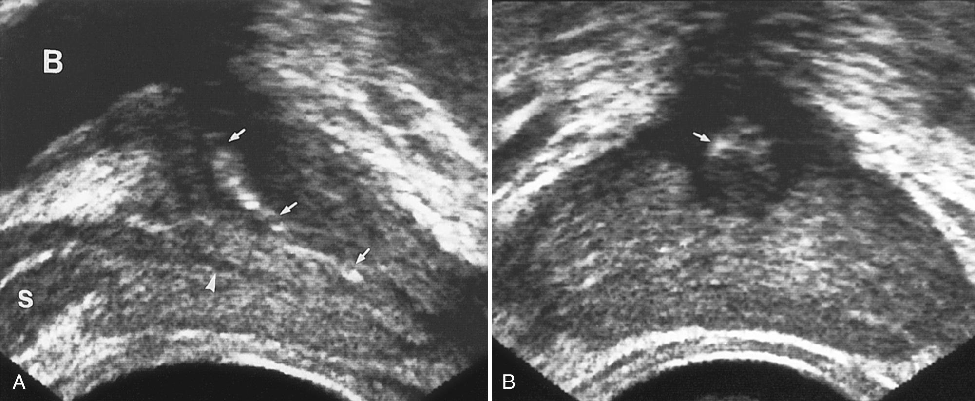 FIG. 9.8, Transrectal Ultrasound of Male Urethra.