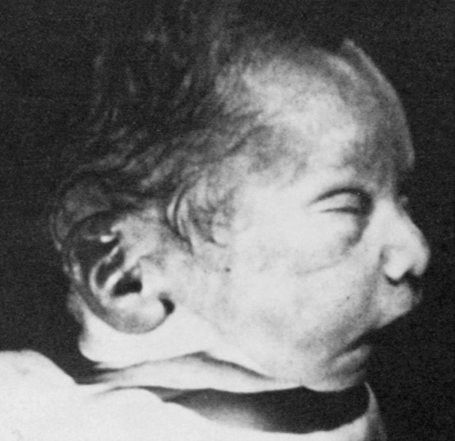 Fig. 93.3, Potter facies. Photomicrograph demonstrates the characteristic findings, including epicanthal folds, hypertelorism, low-set ears, a crease below lower lip, and a receding chin.