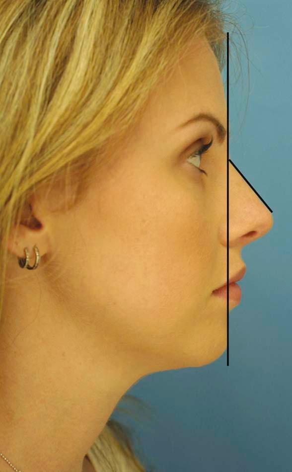 Figure 24-2, The aesthetic facial angle (as described by Joseph) is formed by the intersection of a vertical line dropped from the glabella with a line from the nasion to tip-defining point. Tip projection is optimal with an angle of 30 degrees.