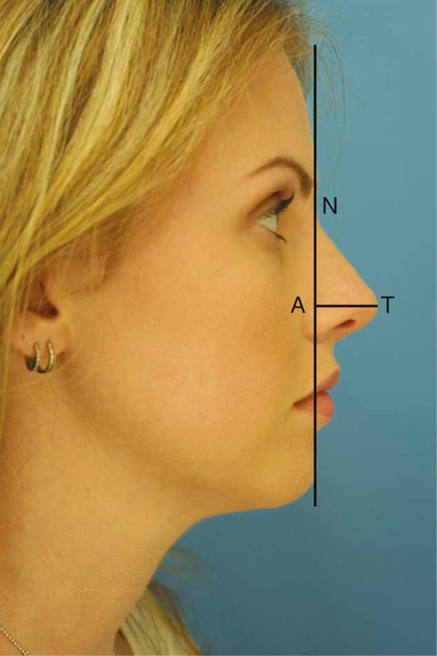 Figure 24-4, Goode's method. Vertical axis is from nasion to the alar groove. The horizontal line is from ala to the tip. Nasal projection should be 60% of nasal length. This is expressed as a ratio with ala-tip–nasion-tip equaling 0.55 to 0.60.