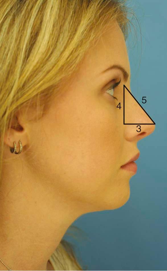 Figure 24-5, In the 3:4:5 triangle, the ratio of projection to length is represented by the ratio 3 : 5. In accordance with Goode's method, nasal projection is 60% of nasal length.
