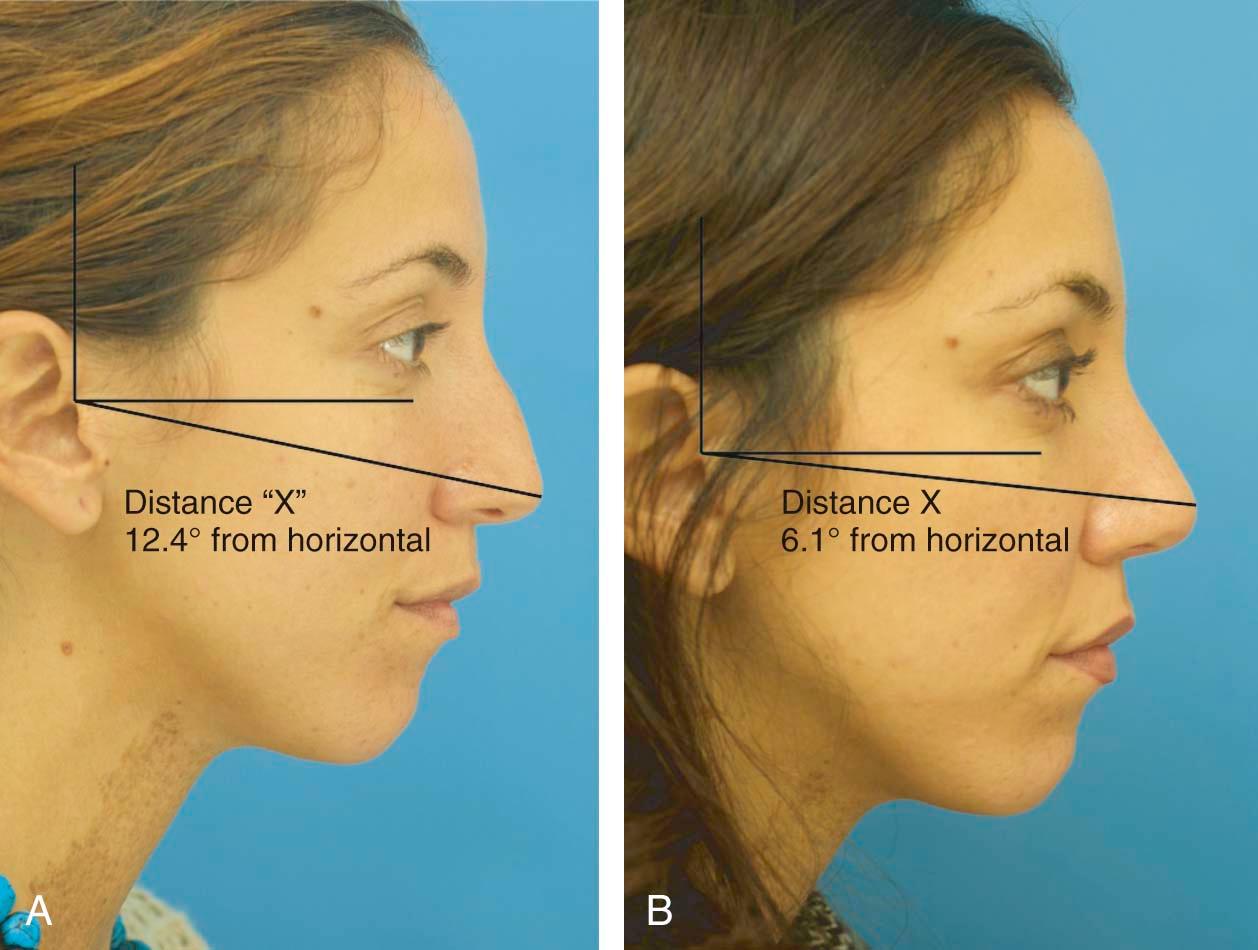 Figure 24-6, As described by Simons, as the nasal tip rotates through an arc, there is an apparent increase in nasal projection, although none exists. A, “X” is the distance from the tragus to the nasal tip. The angle from the horizontal is 12.4 degrees. B, The distance from tragus to tip remains the same while the angle from the horizontal significantly decreases to 6.1 degrees. The illusion is one of increased projection while all that has occurred is increased rotation.