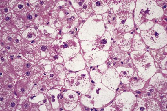 Fig. 16.2, Liver-cell ballooning after transplantation.