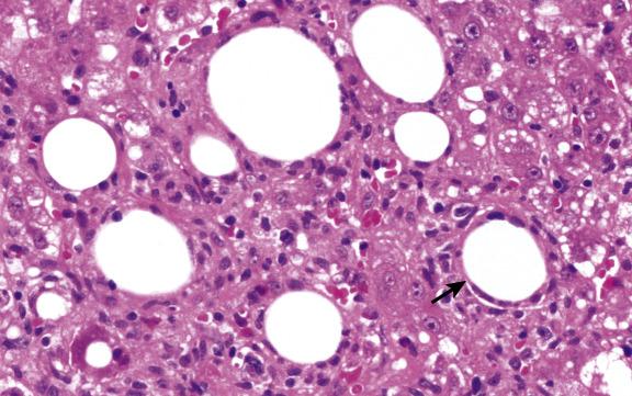 Fig. 16.3, Lipopeliosis.