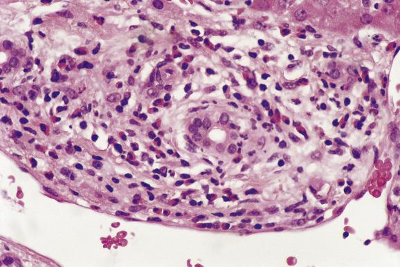 Fig. 16.6, Acute rejection.