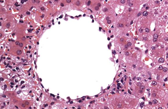 Fig. 16.8, Endotheliitis in acute rejection.