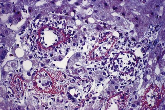 Fig. 15.3, Q fever.